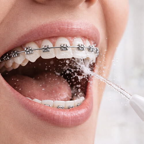 Процесс чистки зубов с брекетами ирригатором stl di-m01.